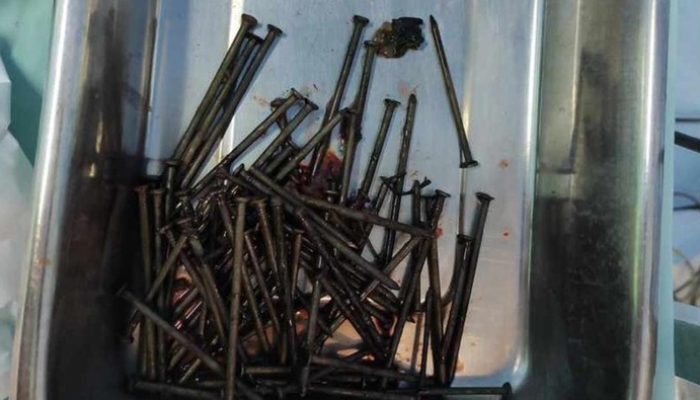 Ngeri! 70 Paku Bersarang Dalam Lambung Pemuda Ini