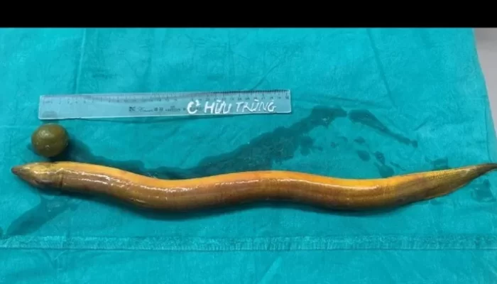 Dokter di Vietnam Keluarkan Belut Dari Dalam Perut Pasien